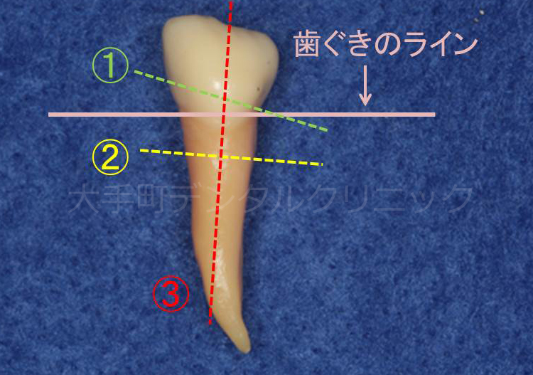 割れた歯（破折歯）の治療法の解説