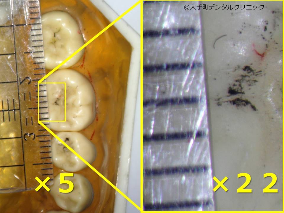 歯科用の拡大鏡と顕微鏡との視野の比較