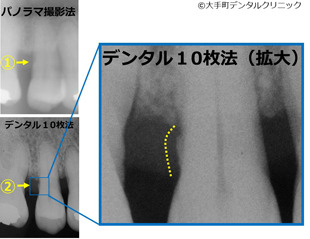 歯周病治療で撮影するレントゲンの図（拡大)