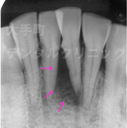 歯周病の治し方（歯周基本治療の例）について