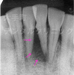 歯周病治療で歯ぐきの骨が再生した例、治療前