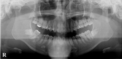 歯医者のレントゲン、パノラマ撮影