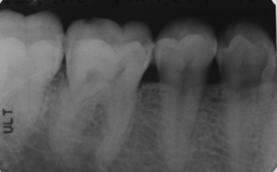 歯医者のレントゲン、デンタル撮影