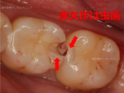 今回のケースの虫歯の状態の解説