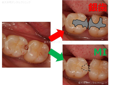 虫歯の治療の治療方法２つの説明