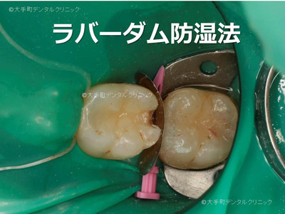 虫歯の治療中の状態