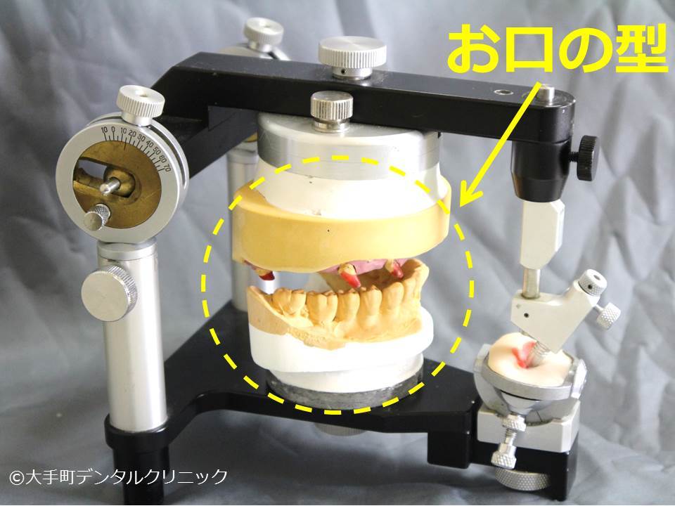 咬みあわせの治療で使う咬合器（こうごうき）って知っていますか？: 大手町、東京駅、丸の内の歯科医ブログ